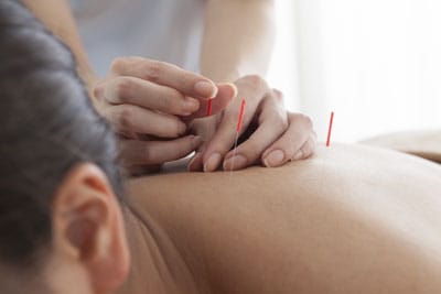 Acupuncture For Pain relieve